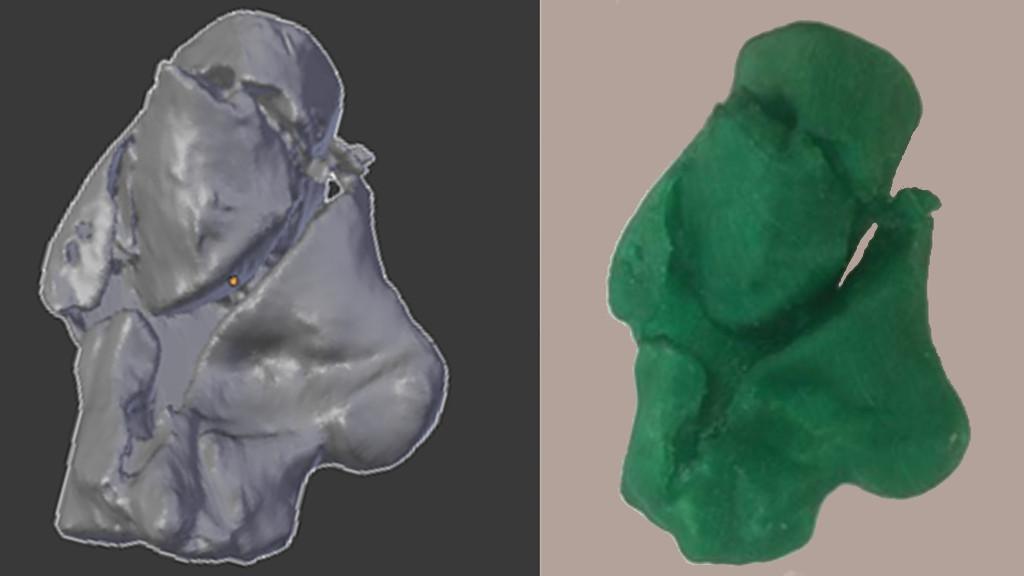 3D Printing in Medicine - Calcaneus Fracture Scan and Print