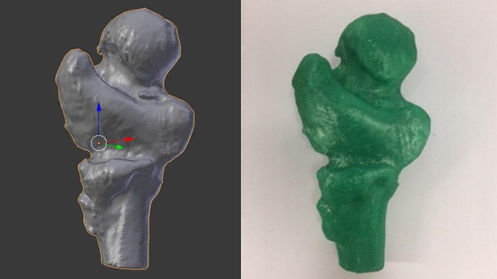 3D Printing in Medicine - Fractured Femur Scan and Print