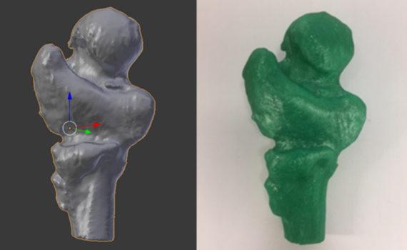 3D Printing in Medicine - Fractured Femur Scan and Print