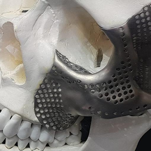 3D Printing in Medicine - Scull with Implant