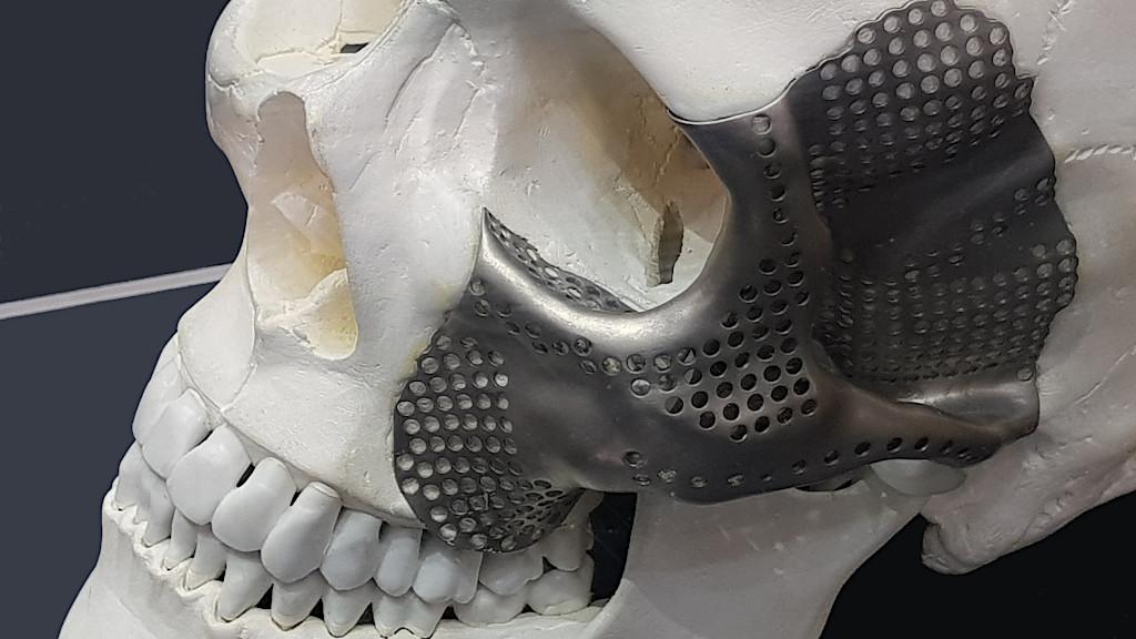 3D Printing in Medicine - Scull with Implant