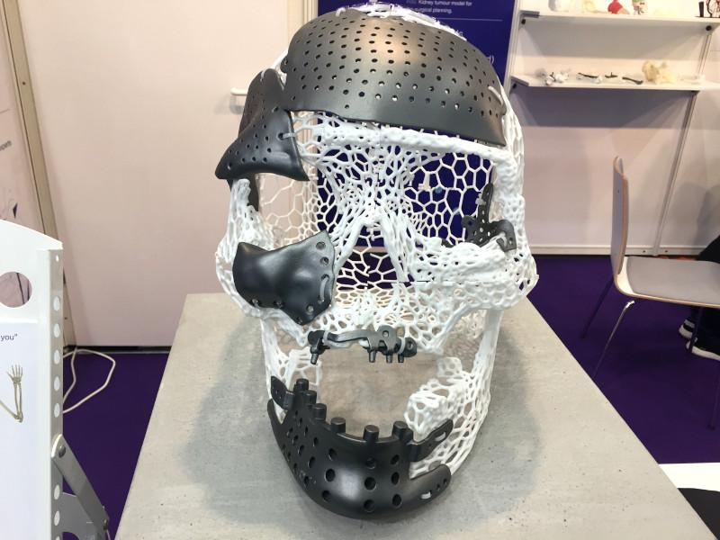3D Printed in Voronoi style skull with Implants